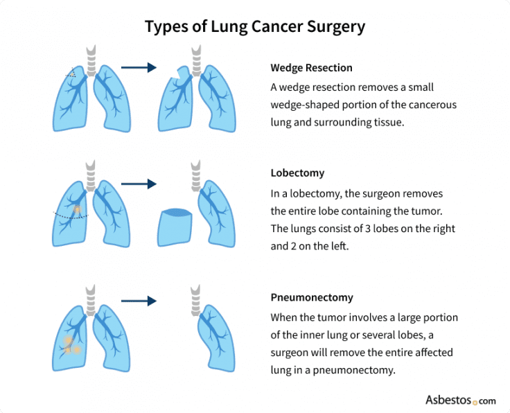 Pleural Cancer Types